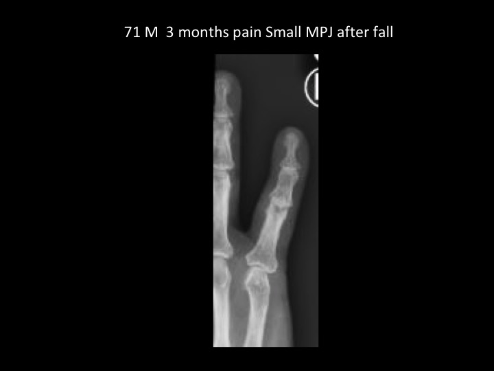 Figure 1 for case radial collateral ligament of metacarpophalangeal joint ( RID2335 )